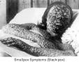 Smallpox victim. One of millions.